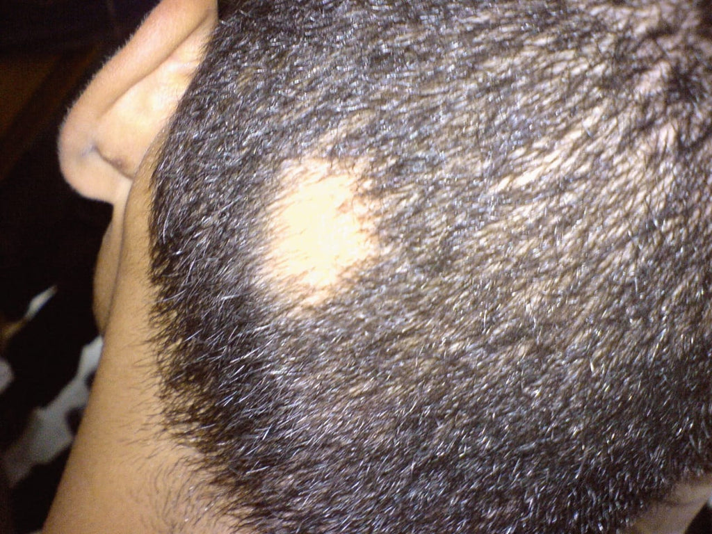 Hair Loss Sessions