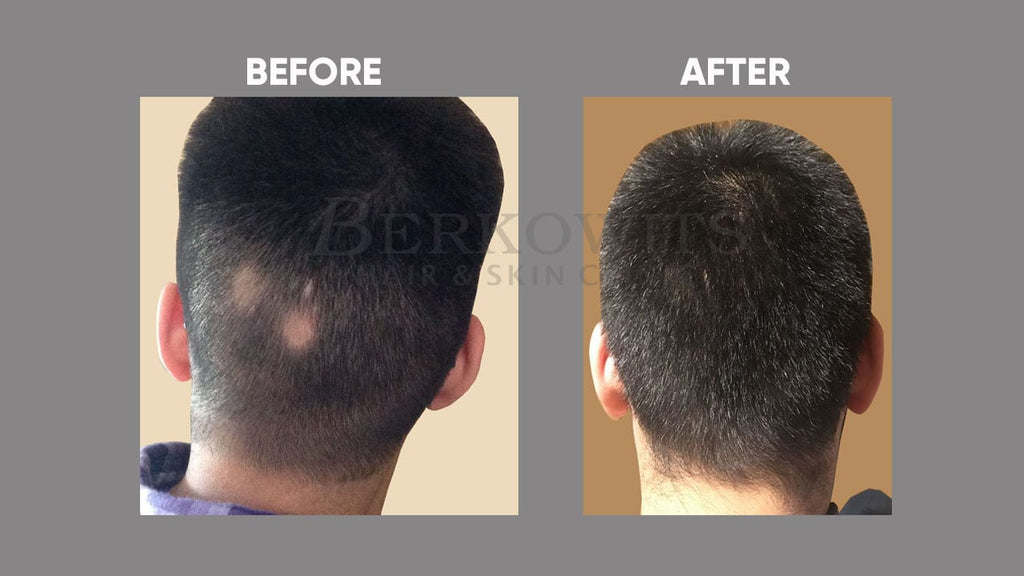 Hair Loss Sessions