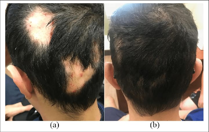 Hair Loss Sessions