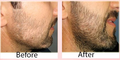 Hair Loss Sessions