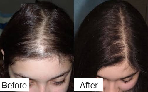 Hair Loss Sessions
