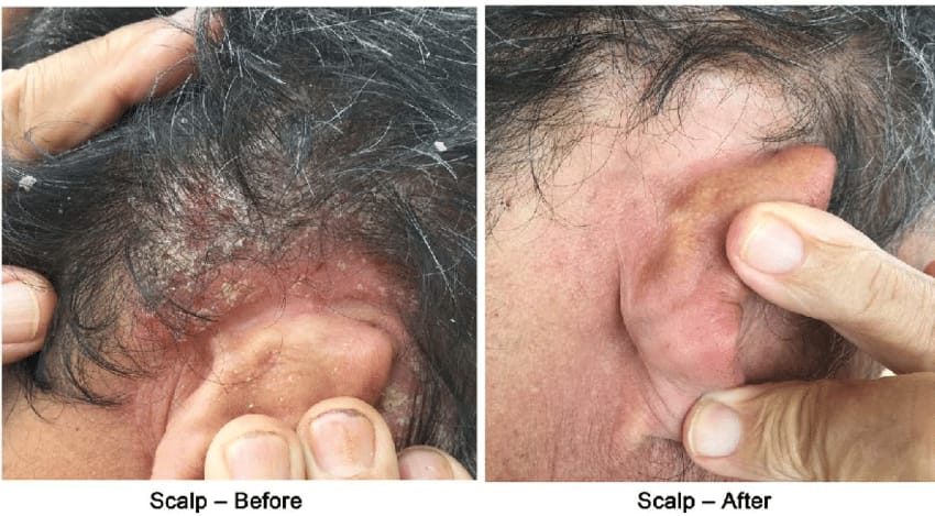 Hair Loss Sessions